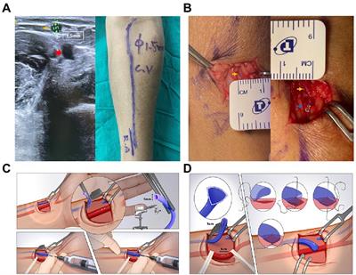 The feasibility of small-caliber veins for autogenous arteriovenous fistula creation: A single-center retrospective study